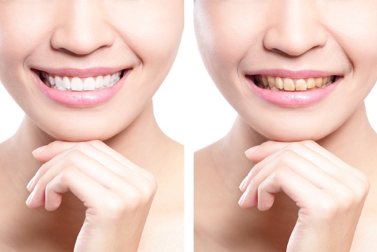 over counter teeth whitening systems