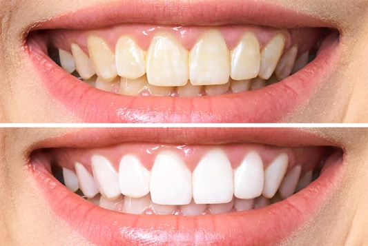 quickest teeth whitening products